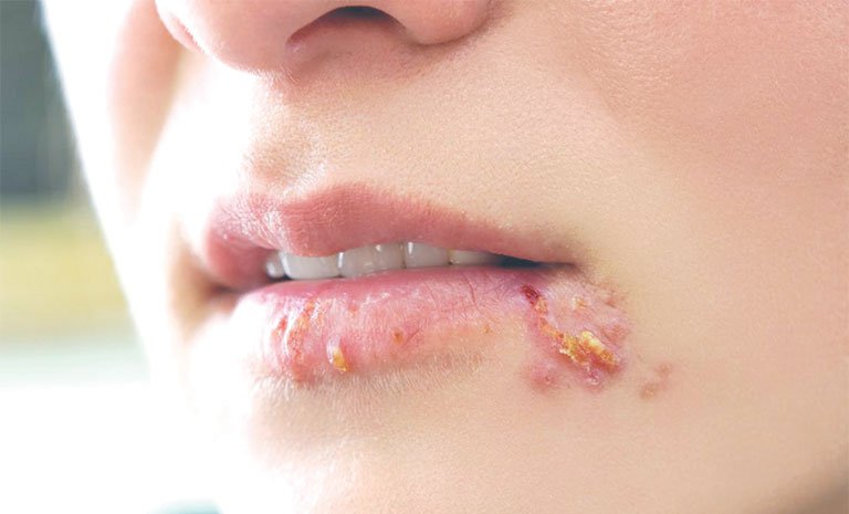 Bụi bẩn và vi khuẩn có vai trò gì trong việc hình thành mụn quanh miệng?
